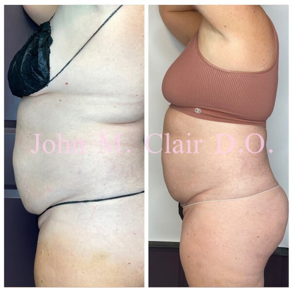 Before and After Image: BodyTite Turbo - left-side