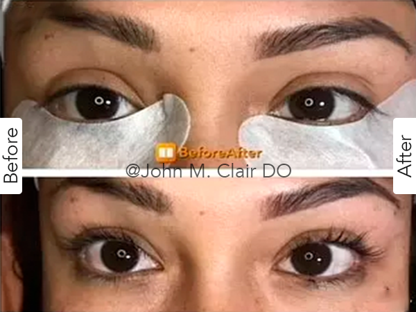 Before and After Image: Lash Lift - front