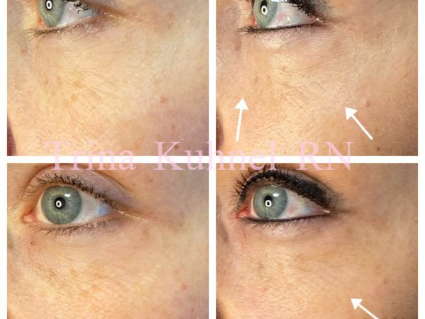 Before and After Image: PRP & PRFM - left-front-oblique