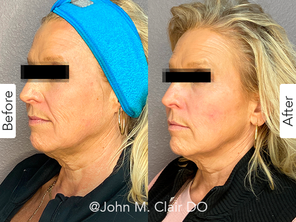Before and After Image: Sculptra - left-front-oblique