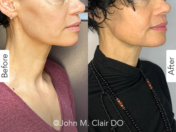 Before and After Image: FaceTite - right-front-oblique