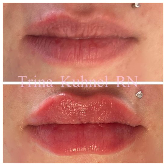 Before and After Image: Lip Filler - front