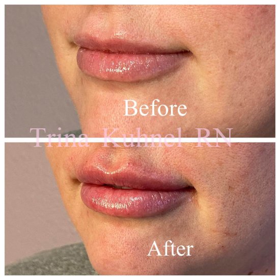 Before and After Image: Lip Filler - left-front-oblique