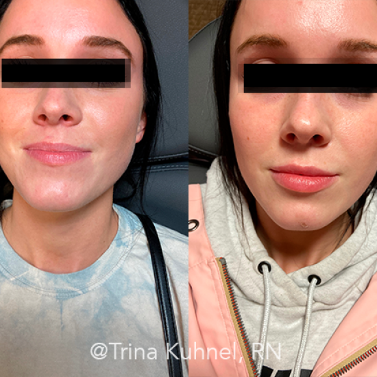 Before and After Image: Lip Filler - front