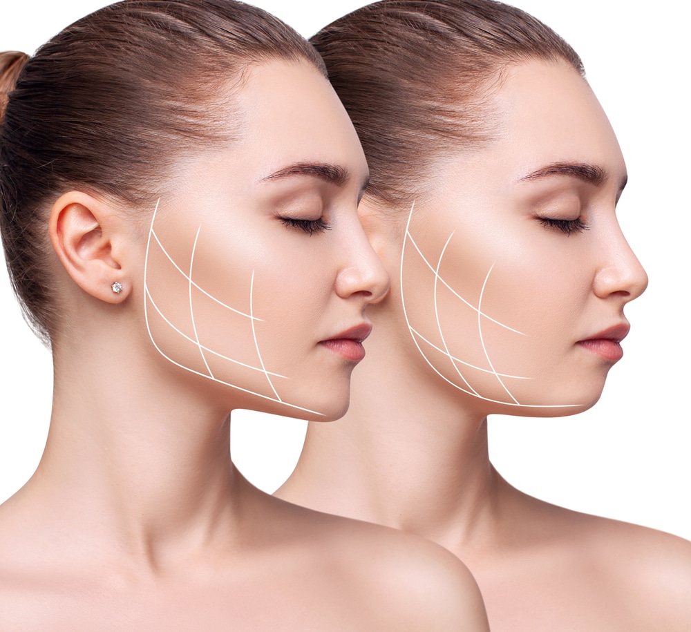 Young woman with lifting lines on her chin, showing before and after results of BodyTite Turbo for face and neck contouring.