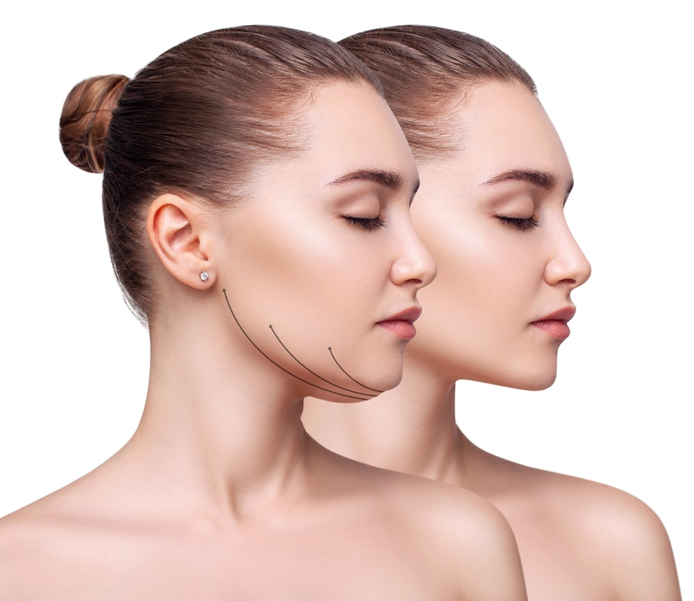 Before and After Kybella Williams County ND